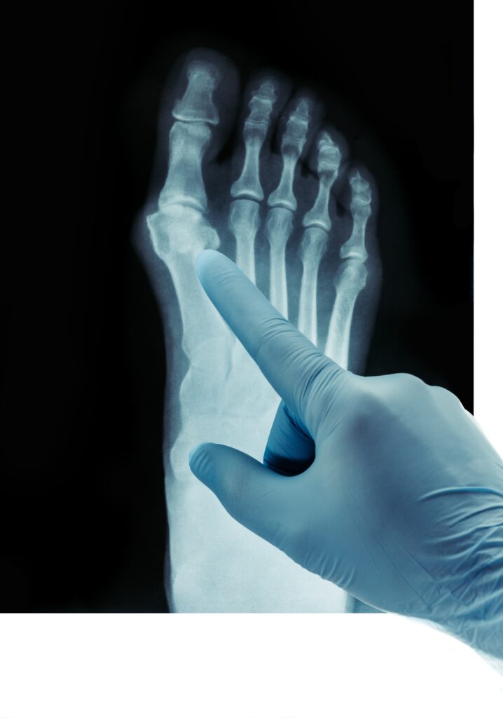 Hallux Rigidus