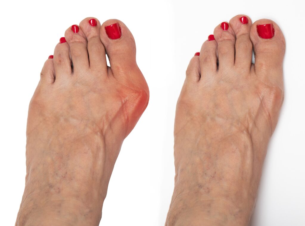 Hallux valgus